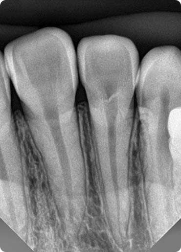 Incisor