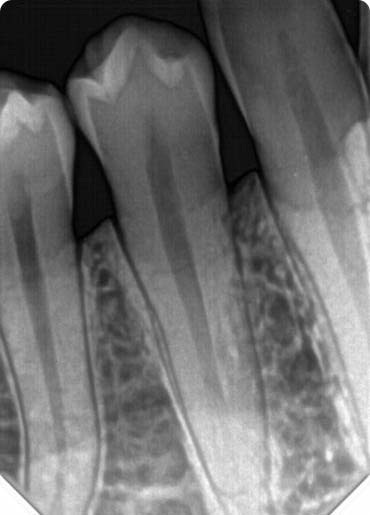 Premolar