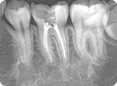 Tooth Decay