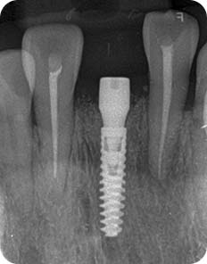 Post-implant Healing Assessment