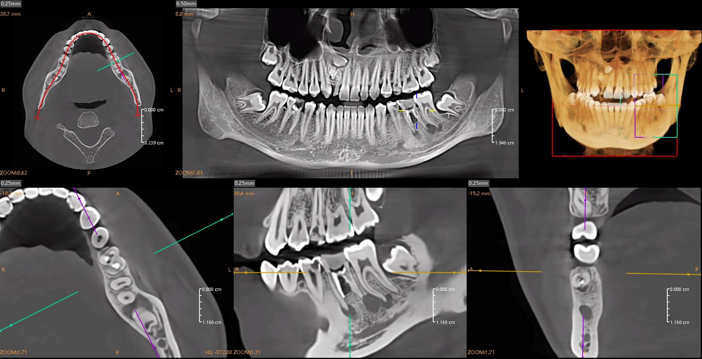 Implant Planning