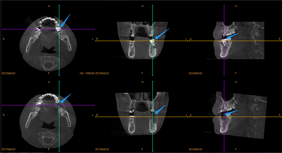 CT Effect Comparison
