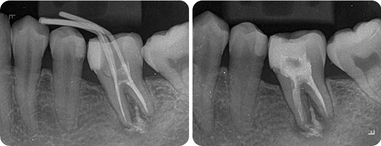 Before and After Root Canal Therapy
